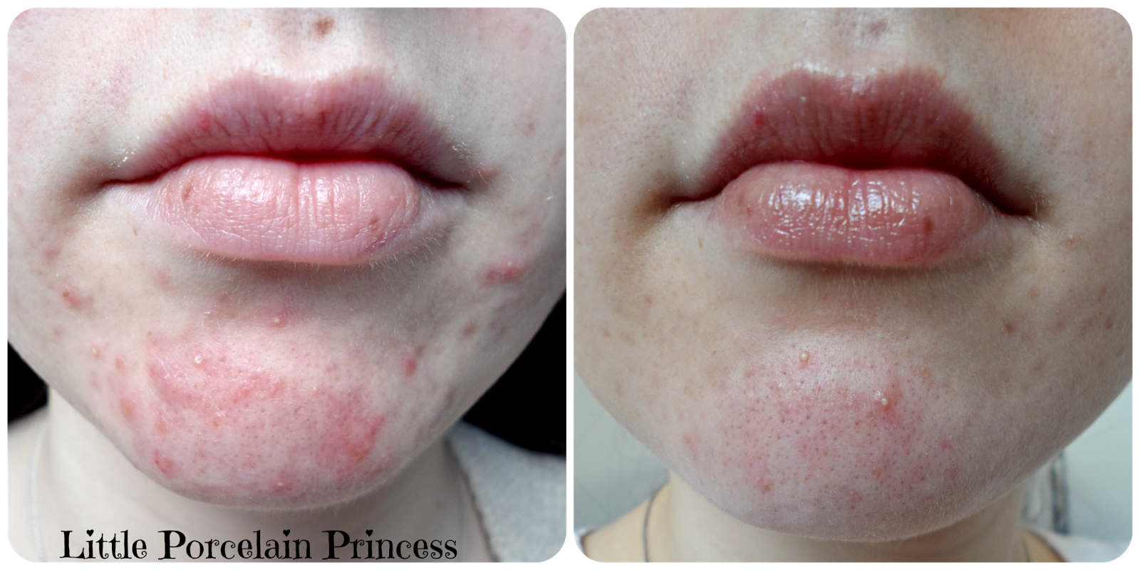 facial eczema and hormones hd photo nude pinay